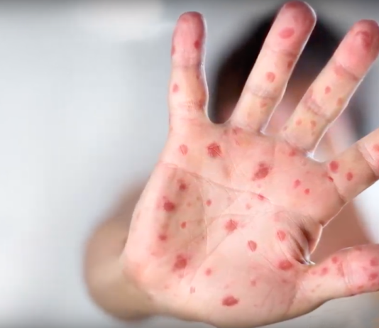 Measles outbreak, vaccines