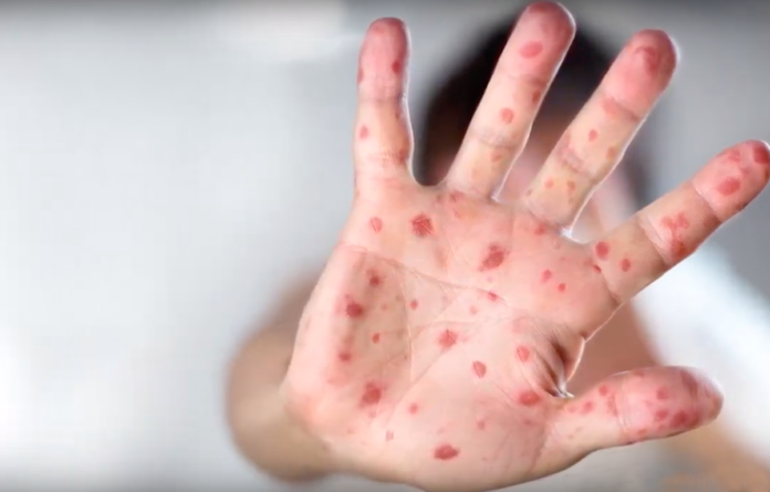 Measles outbreak, vaccines